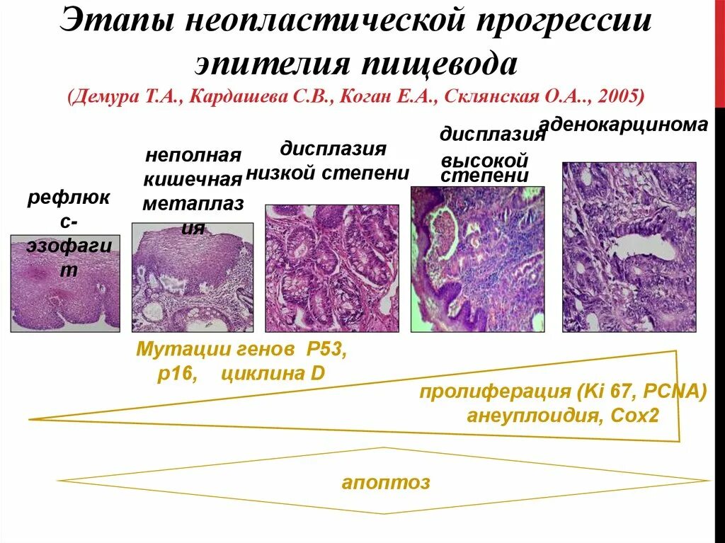 Плоское интраэпителиальное поражение низкой степени. Дисплазия низкой степени. Дисплазия высокой степени. Дисплазия бронхиального эпителия.