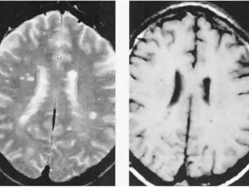 Многоочаговое поражение мозга. Понтинный миелинолиз. Демиелинизирующий энцефалит мрт. Демиелинизирующие очаги головного мозга. Демиелинизирующее заболевание ЦНС.