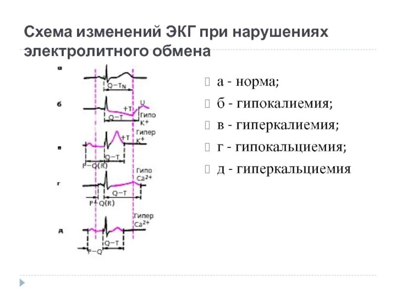 Экг при гипотиреозе. Экг при гипотиреозе. Тиреотоксикоз изменения на экг. Аг при гипотиреозе патогенез. Электролитные нарушения на экг.