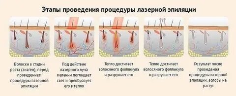 Что происходит после первой лазерной