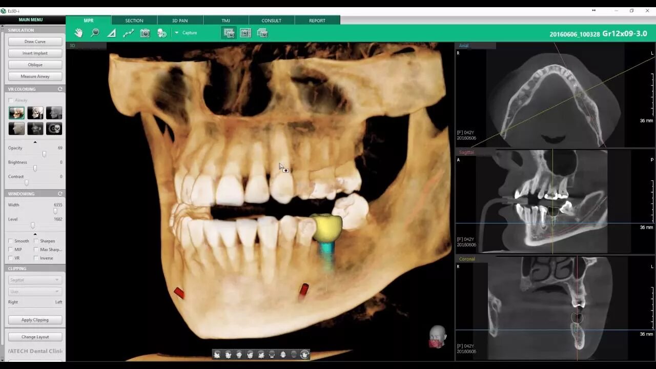 Компьютерный томограф VATECH Pax-i3d с цефалостатом. Аппарат кт зубов VATECH. Компьютерная томография Ватек. Компьютерная томография кт челюсти. Ez3d2009