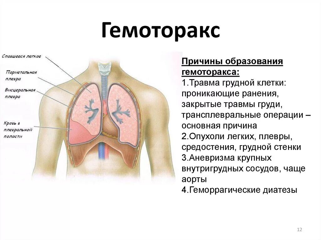 Гемоторакс причины. Гемоторакс кровотечение.