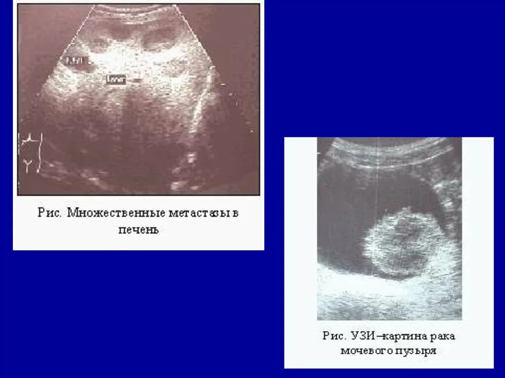 Множественные метастазы в печени УЗИ. УЗИ картина метастазов в печени. Эхограмма печени с метастазами. Рак метастазы в печень лечение