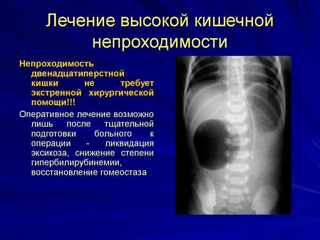 Симптомы непроходимости кишечника у взрослых. Клиника обтурационной кишечной непроходимости. врожденная высокая кишечная непроходимость рентген. врожденная кишечная непроходимость рентген. непроходимость кишечника.