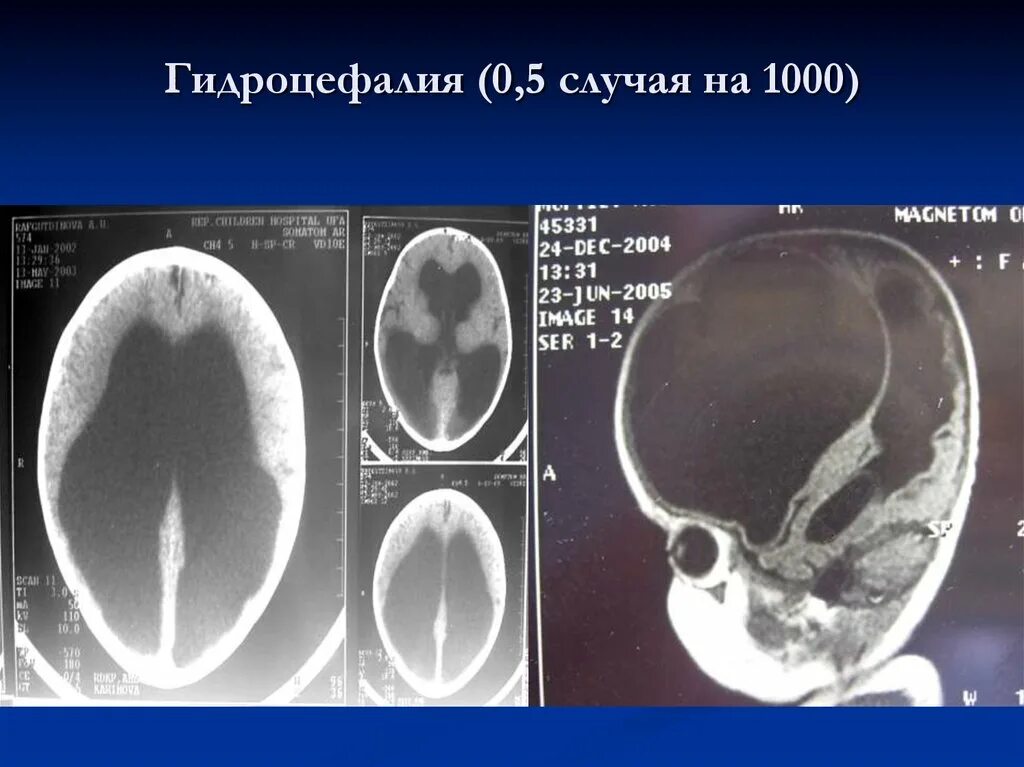 Как лечить гидроцефалию