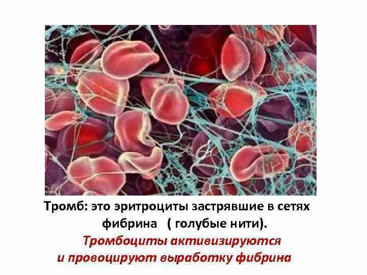 Тромбоциты образование тромба. Образование нитей фибрина. Тромбоциты и тромбы