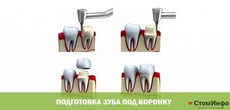 Можно на корни поставить зубы