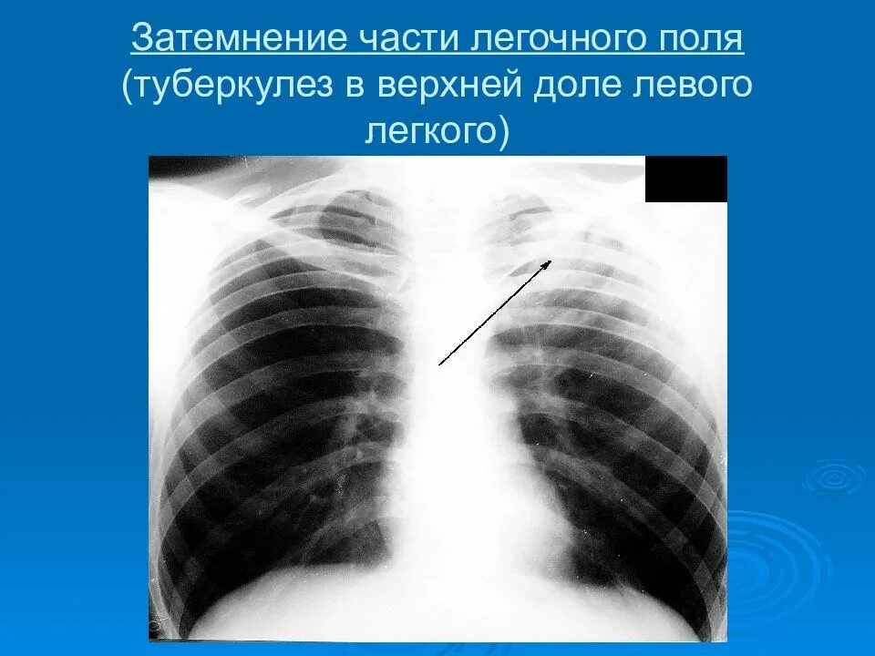 Доли легкого на рентгенограмме. Рентген легких затемнение легкого. Очаговый туберкулез легких рентген признаки. Затемнения лёгких на рентгене легких. Участки затемнения в легких.