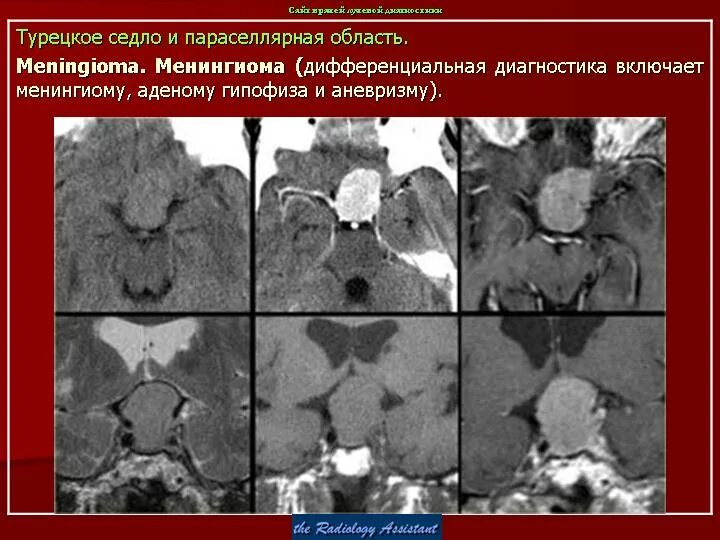 Образование турецкого седла. Параселлярная менингиома. Менингиома гипофиза кт. Менингиомы селлярной области. Менингиома аденома гипофиза.