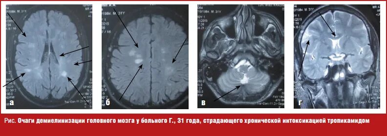 Что значит очаг в головном мозге. Демиелинизация головного мозга мрт. Очаги демиелинизации. Очаги демиелинизации головного мозга что это такое. Очаги демиелинизации на мрт.