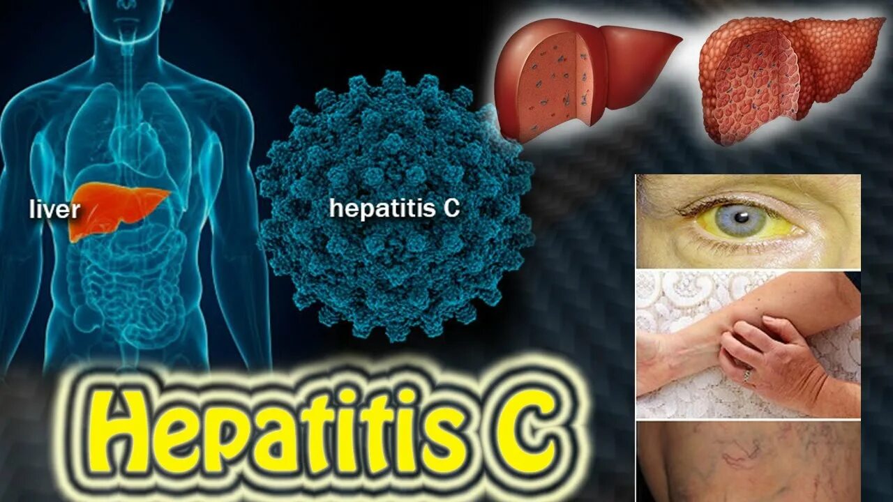 Гепатит c. Вирусные гепатиты.