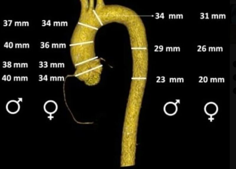 Проксимальная дуга аорты. Дуга аорты норма узи. Размеры аорты. Отделы аорты анатомия схема. Сегменты аорты.