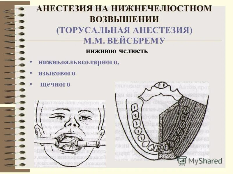 Через сколько отходит анестезия зуба. Торусальная анестезия нижней челюсти. торусальная анестезия зона обезболивания. анестезия нижней челюсти зоны обезболивания. методика проведения торусальной анестезии.