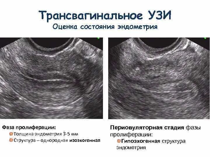 Трехслойная структура эндометрия (УЗИ). Эндометрий на 5 день цикла по УЗИ. Эндометрий на УЗИ норма и патология. Эндометрий фазы пролиферации на УЗИ.