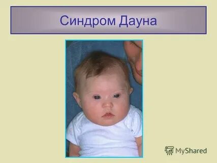 Новорожденные с синдромом дауна как выглядят фото