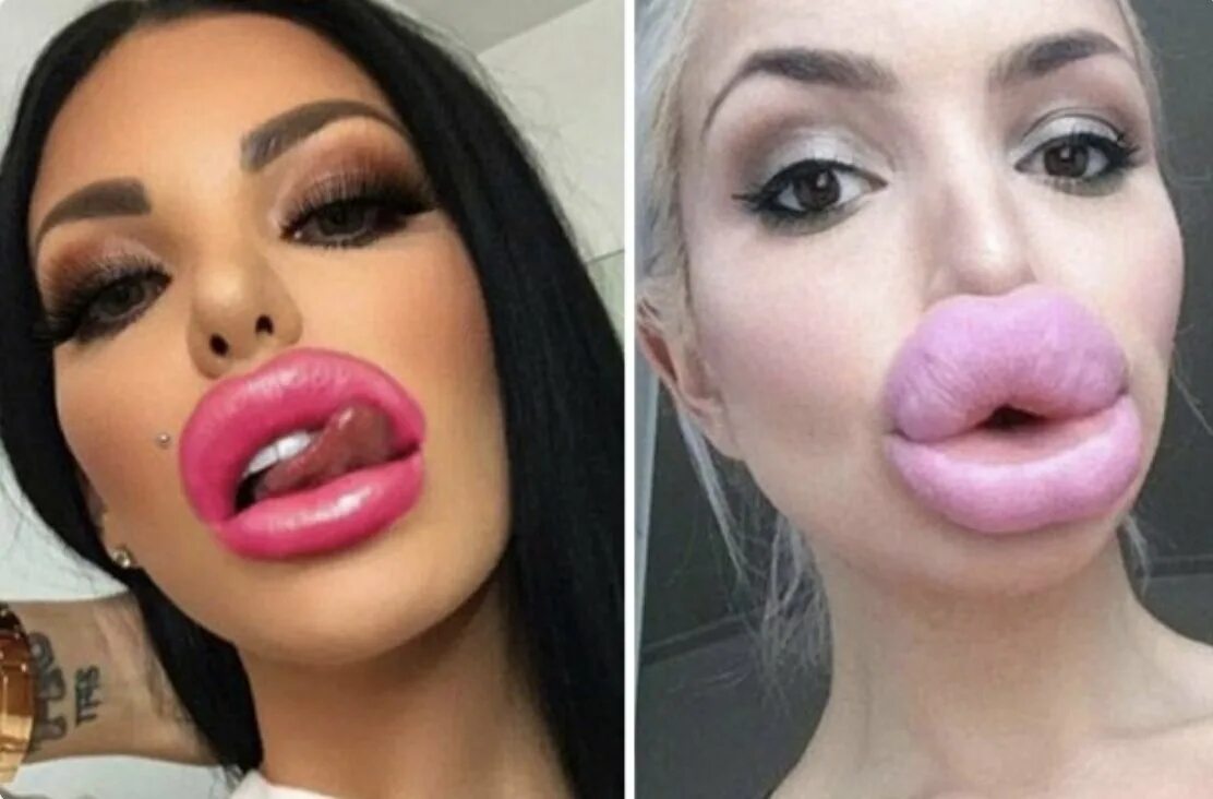 Огромные губы с ботоксом. Жесткие губы. Увеличенные губы красивые. Красивая форма губ. Жесткие губы.