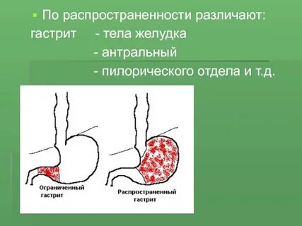 Антральный гастрит активность