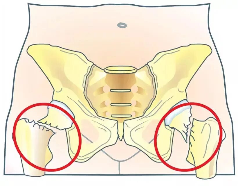 Перелом таза и шейки бедра. Вколоченный перелом шейки бедра. Трещина шейки