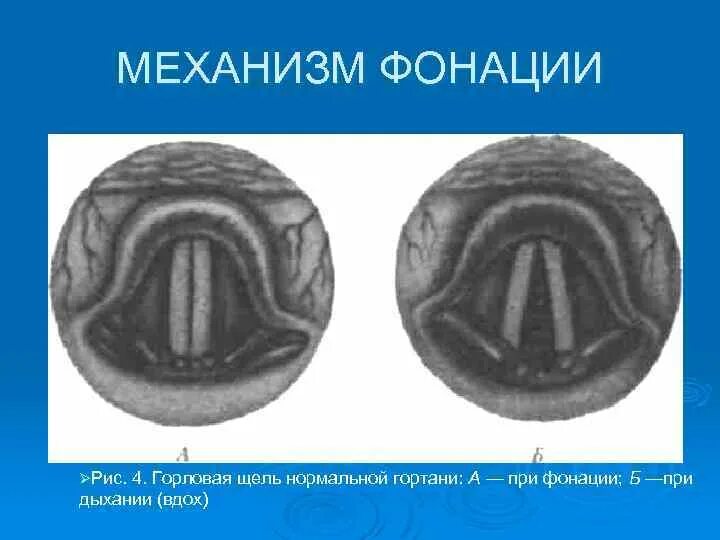 Горловые буквы. Голосовые складки при фонации кт. Кт гортани при фонации.