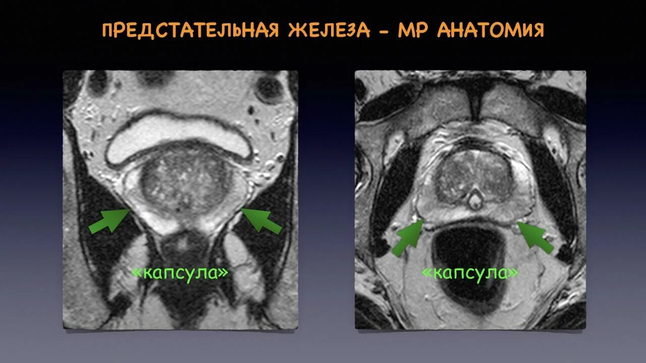 Аденоматозные узлы предстательной железы мрт. Мультипараметрическое мрт предстательной железы. Pirads мрт предстательной железы. Зональная анатомия предстательной железы мрт. Аденома простаты мрт