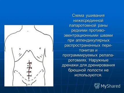 Экг брюшной полости