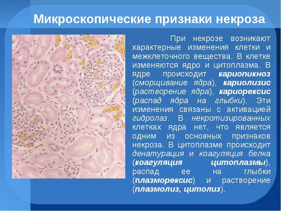 Колликвационный некроз клетки. Микроскопические признаки некроза. Микросклпические признаки невроз. Макроскопические признаки некроза.