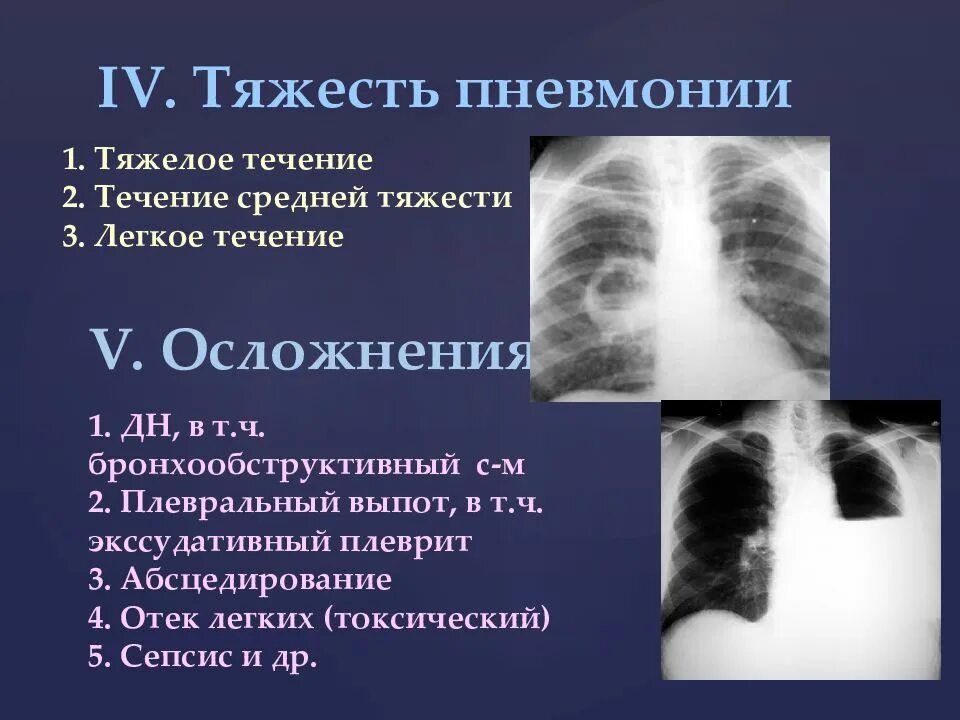 Воспаление лёгких средней тяжести. Тяжелая и средняя пневмония. Двухсторонняя пневмония.