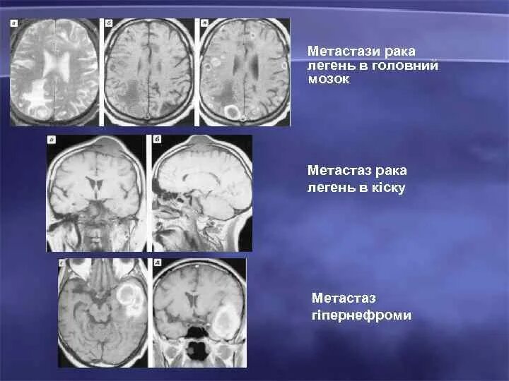 Отек мозга метастазы. Как выглядят метастазы в головном мозге.