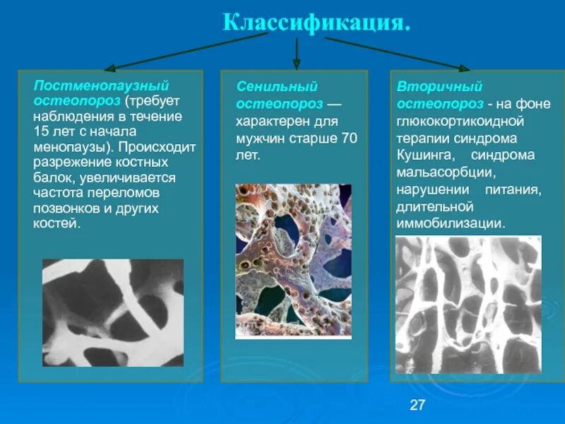 Проблемы остеопороза. Первичный остеопороз. классификация остеопороза. первичный и вторичный остеопороз. вторичный остеопороз.