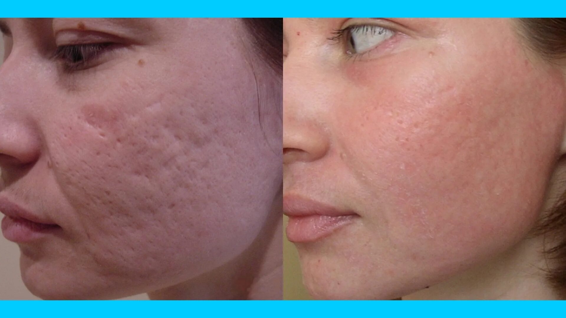 Лазерная шлифовка кожи цена skinlift ru. Фотолечение акне/постакне. Шлифовка со2 лазером постакне. Лазерная шлифовка постакне Deka.