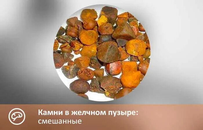 Екатеринбург удаление желчных камней. Екатеринбург удаление желчных камней. Билирубиновые (пигментные) камни. Желчекаменная болезнь камни. Холестериновые камни в желчном пузыре.