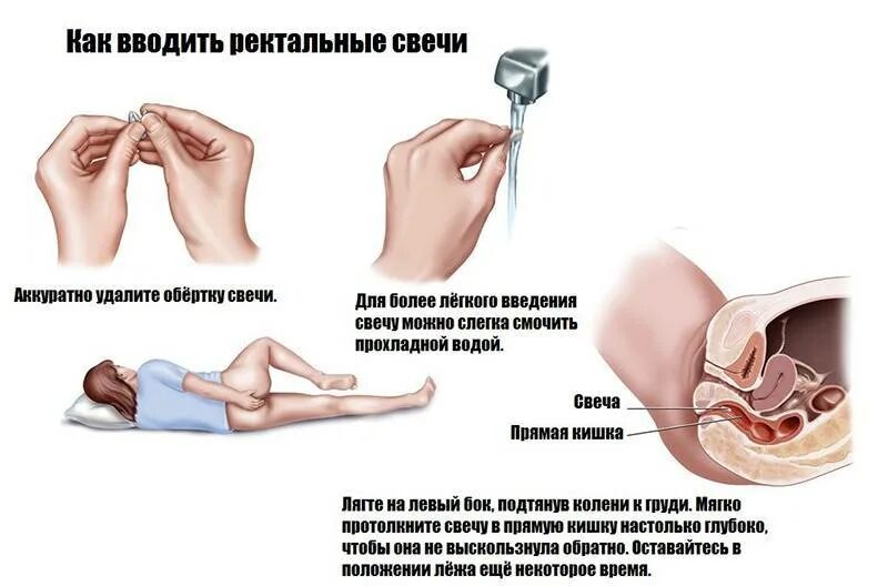 Как вводить свечи ректально женщине