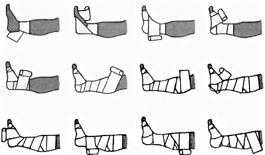 Эластичное бинтование конечности. Правильно забинтовать голеностоп эластичным бинтом. Бинтование нижних конечностей эластичным бинтом алгоритм. Эластичное бинтование нижних конечностей. Бинтование эластичным бинтом голеностопного сустава.