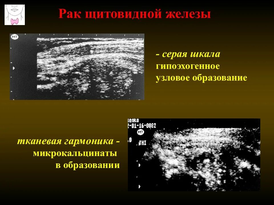 Гипоэхогенное округлое образование. УЗИ щитовидной железы гипоэхогенное образование. Гипоэхогенные участки щитовидной железы что это. Гипоэхогенный узел щитовидной железы на УЗИ. Гипоэхогенное образование щитовидной железы.