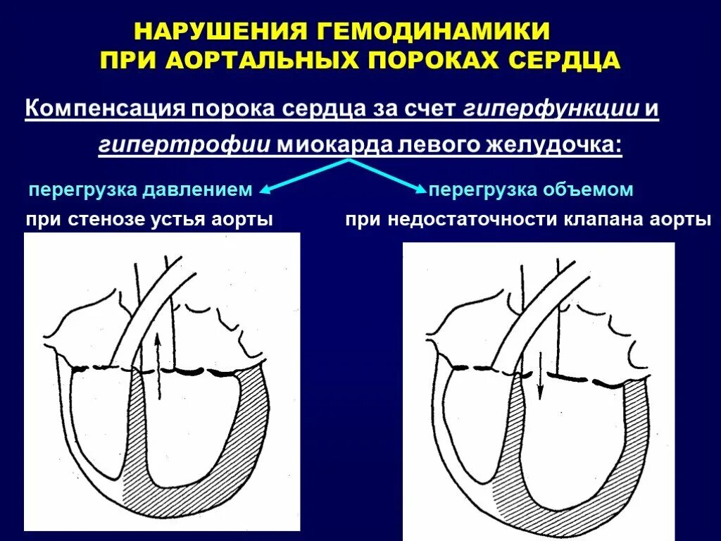 Нарушение гемодинамики сердца