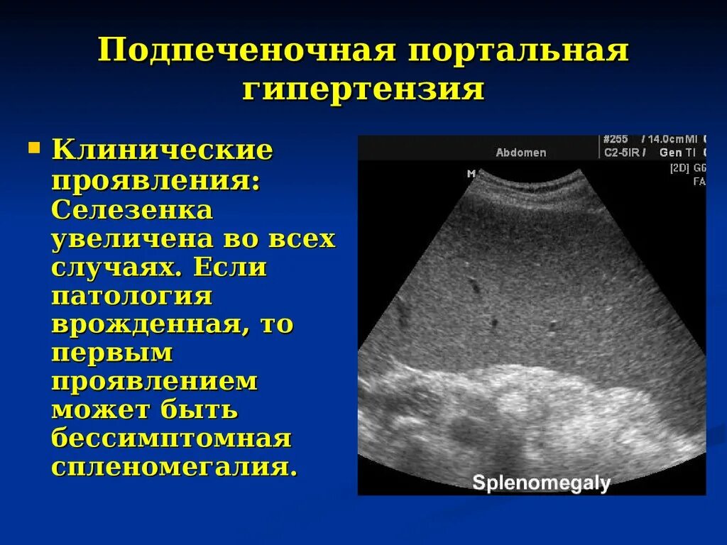 Кальцинаты селезенки. Синдром портальной гипертензии УЗИ. Надпеченочная портальная гипертензия УЗИ. Телеангиэктазия портальная гипертензия. Цирроз УЗИ воротная Вена.