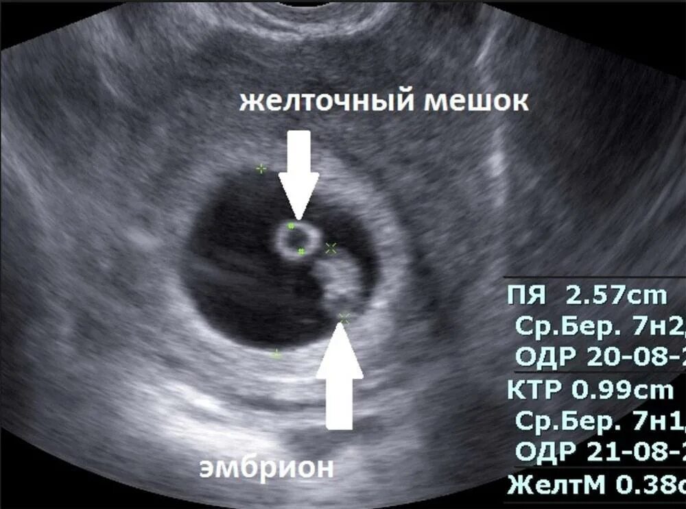 Узи неделя задержки. УЗИ 6 недель беременности желточный мешок. Плодное яйцо с эмбрионом и желточным мешком. УЗИ плодного яйца на 5 неделе беременности. Плодное яйцо на 6 неделе беременности УЗИ.