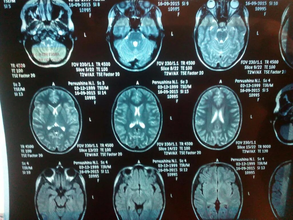 Мрт головного мозга цена нижний новгород. Мрт головного мозга. Мрт мозга. Мрт снимок. Снимок мрт головы.