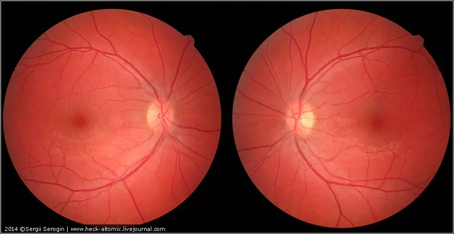 Сетчатки обоих глаз. Офтальмоскопия глазного дна норма. Офтальмоскопия сетчатки. Сетчатка норма офтальмоскопия.