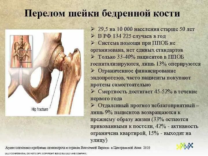 Шейки бедра у пожилых где где