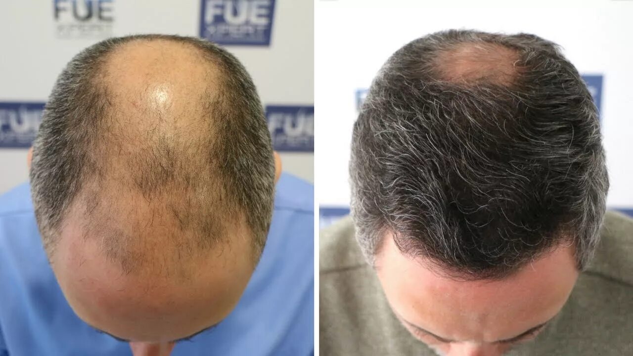 Люди после пересадки волос. Fue clinic отзывы. Бока-ратон hair transplantation clinica. Fue clinic отзывы. Москва олонецкая улица 4 fue clinic.