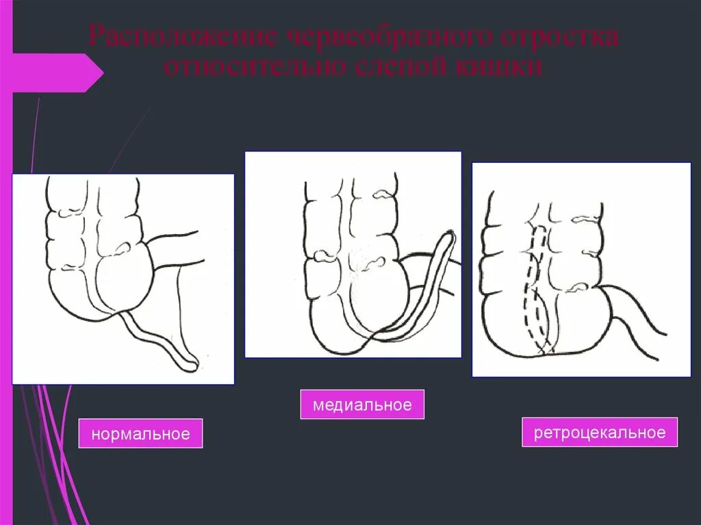 Как называется червеобразный отросток