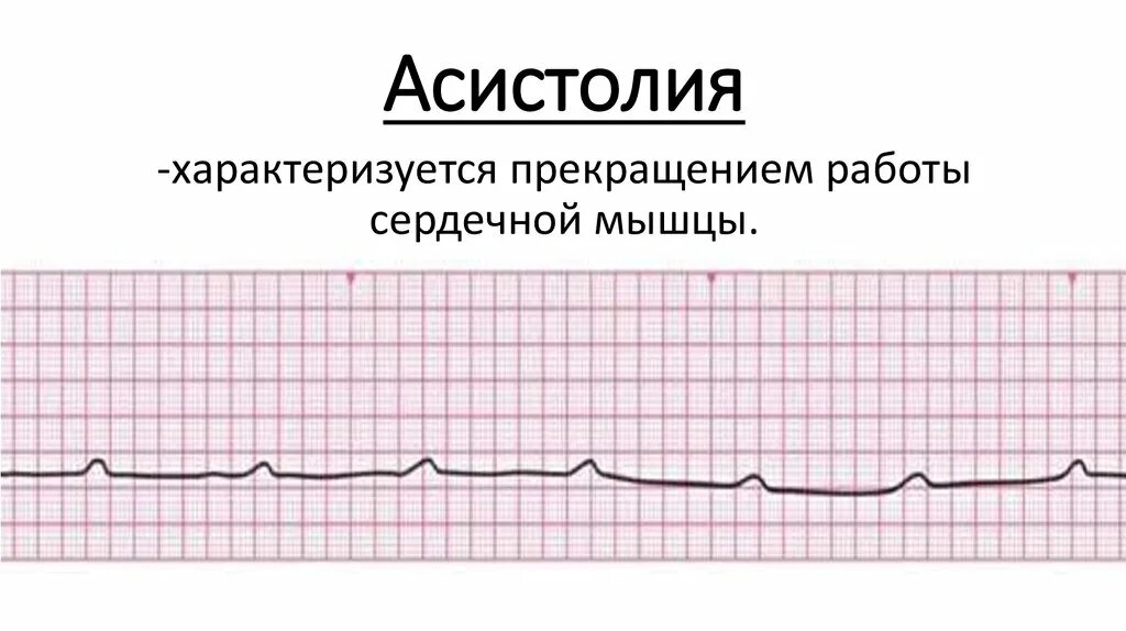 Асистолия что это. Асистолия желудочков на ЭКГ. ЭКГ признаки асистолии желудочков. Изолиния на ЭКГ асистолия. Фибрилляция желудочков на ЭКГ.