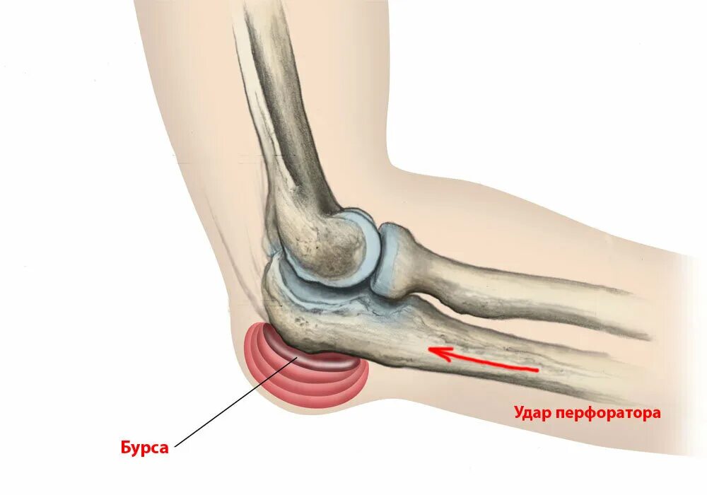 Бурмит отростка локтевого. Синовиальные сумки локтевого сустава. Воспаление кости локтевого сустава. Синовиальные сумки локтевого сустава бурсит.