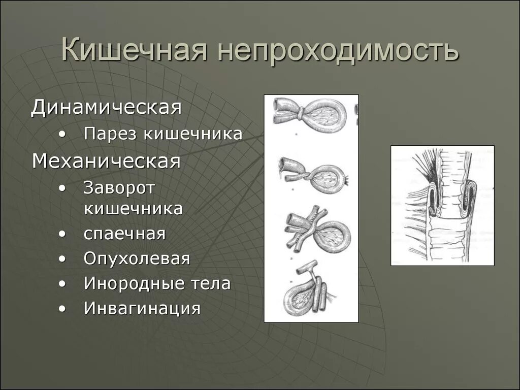 Парез кишечника операция