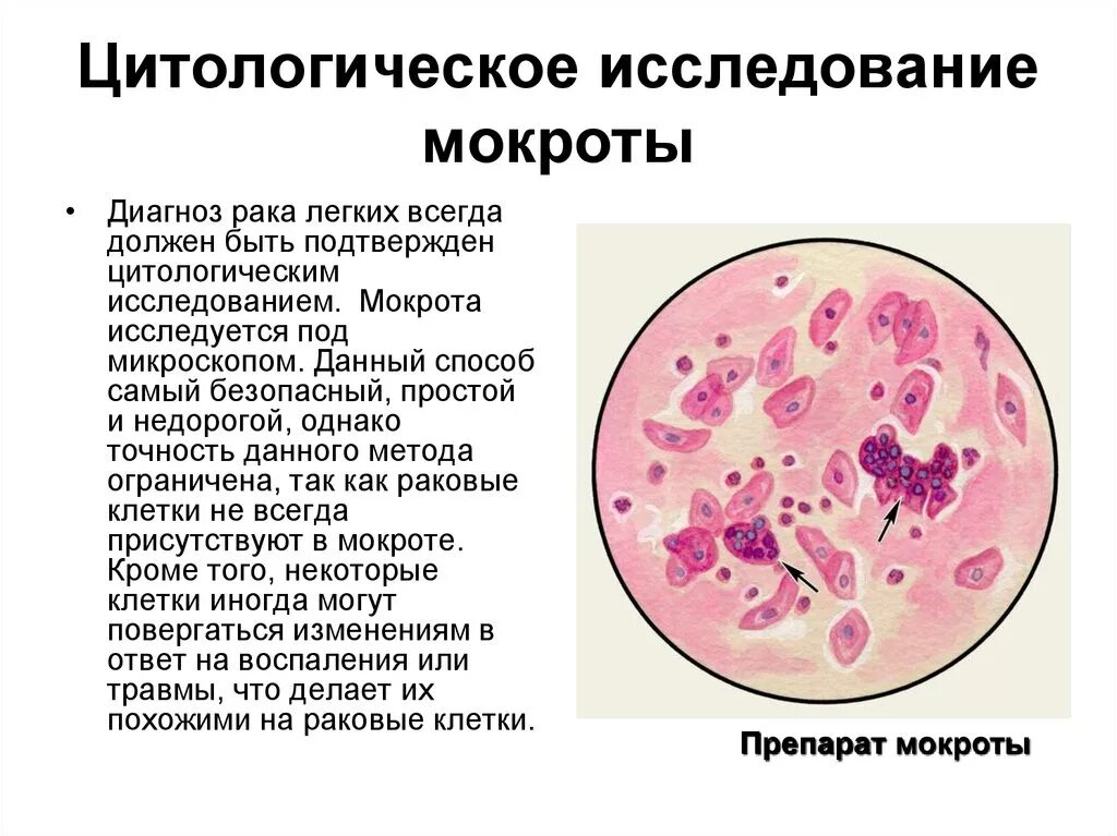 Реакция мокроты. Исследование мокроты спирали Куршмана. Мокрота нативный препарат микроскопия. Мерцательный эпителий в мокроте микроскопия. Клетки при микроскопии мокроты.