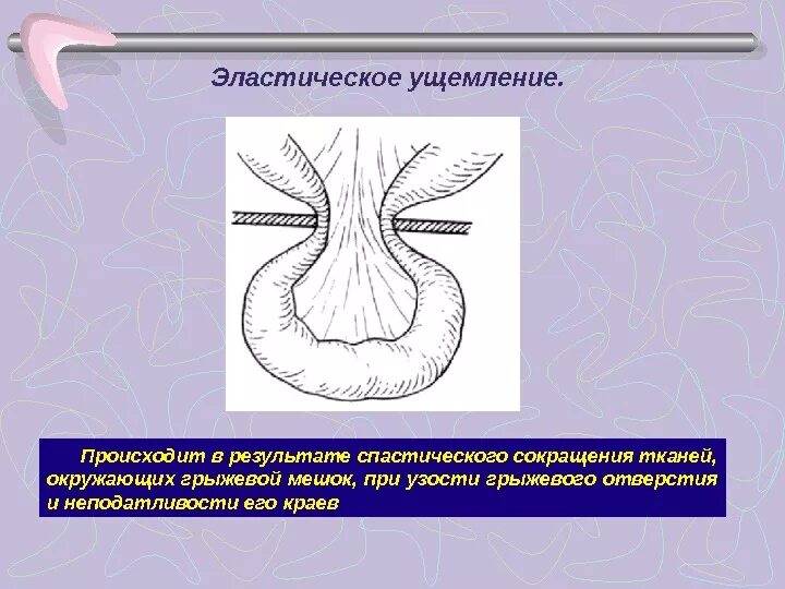 Эластическое ущемление грыжи. Ущемленная грыжа эластическая. Механизм калового ущемления грыжи. Эластическое ущемление грыжи механизм.