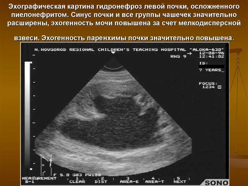 Изменение левой почки. Повышение эхоплотности паренхимы почек. Гидронефротическая трансформация УЗИ. Гидронефротическая трансформация почки на УЗИ. Киста паренхимы почки УЗИ.