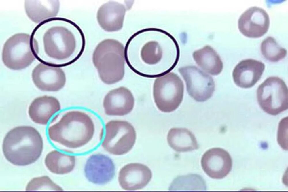 Пониженные макроциты. Гипохромия микроцитоз. Эритроциты мазок гипохромия. Анизоцитоз нормоциты микроциты макроциты. Анизоцитоз мазок крови.
