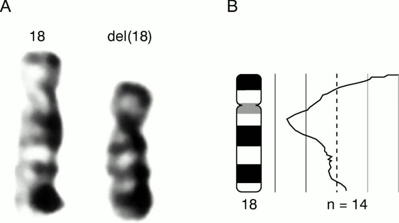 Нарушение 18 хромосомы человека. Бэнд хромосомы. Поворот хромосом на 180 градусов